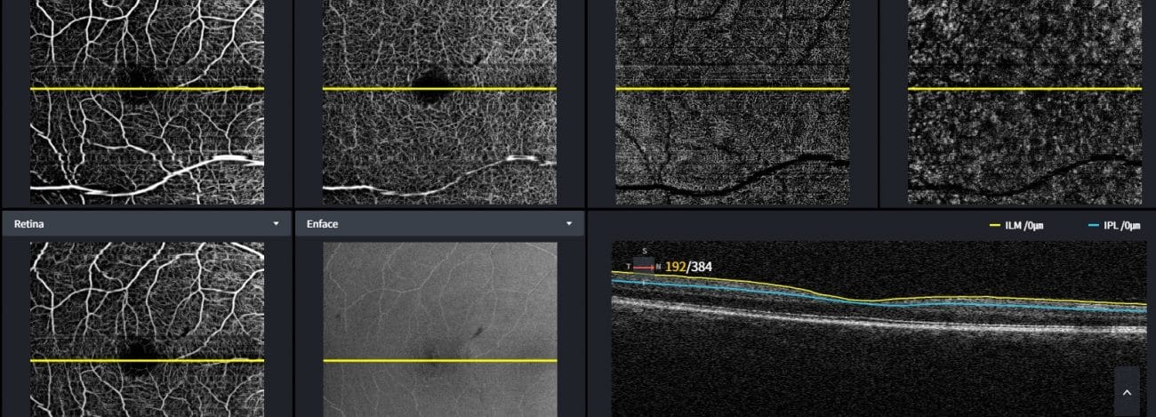 Nieuwe OCT-scanner bij Woldringh Optiek Verlengde Hereweg