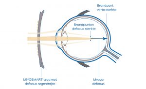 oog met een miyosmart-glas