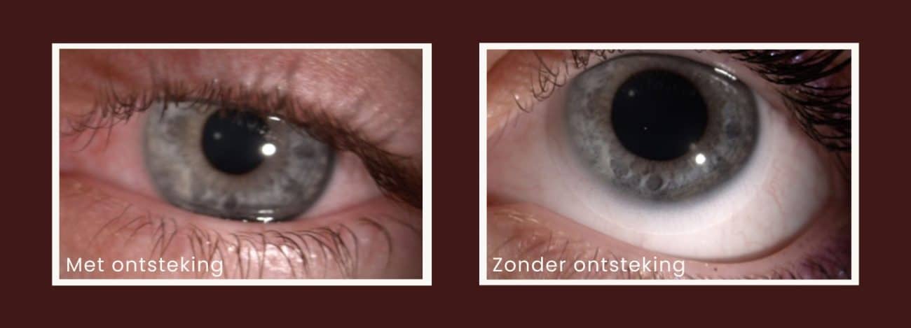 Contactlenzen en zwemmen? Geen goede combinatie.
